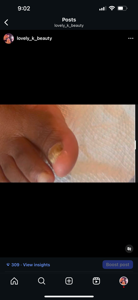 Fungal Acrylic Toes