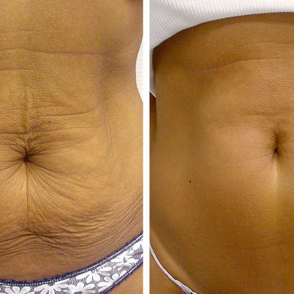 Skin Tightening at The Vanity Club in Atlanta, GA