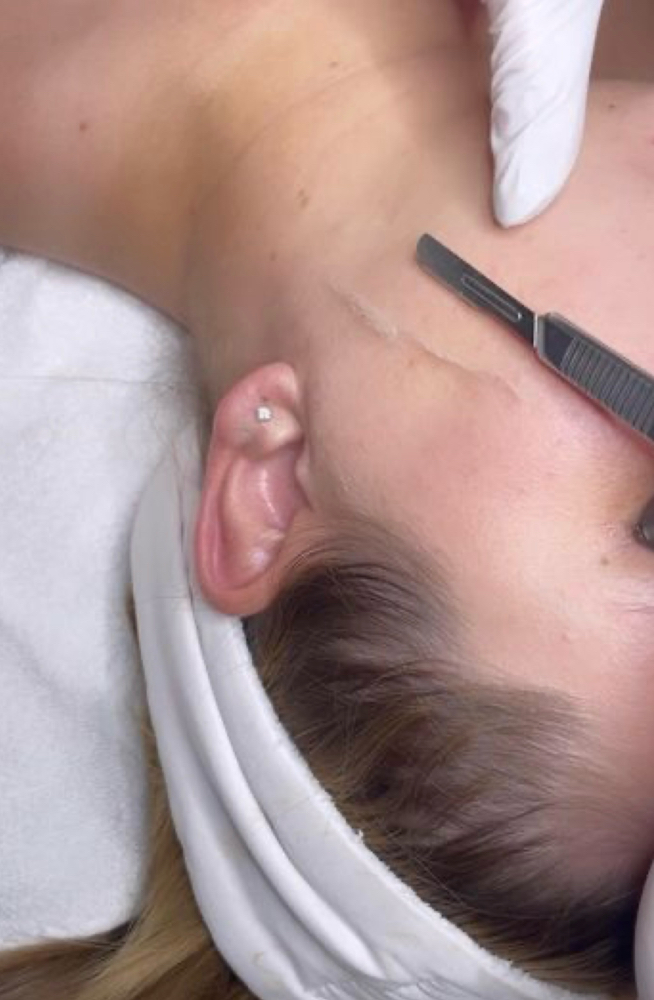 Dermaplane Facial