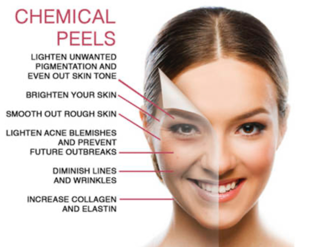 Chemical Peel (Add On Or Seperate)