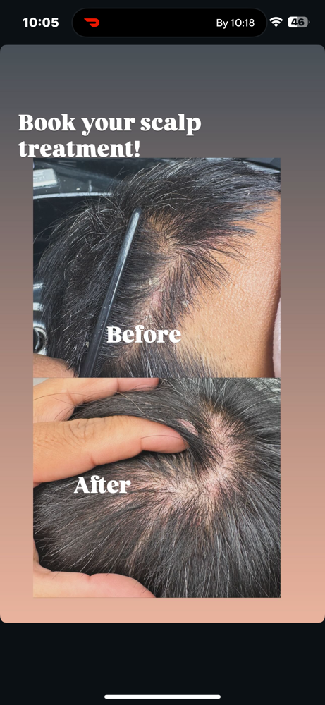 Scalp Treatment