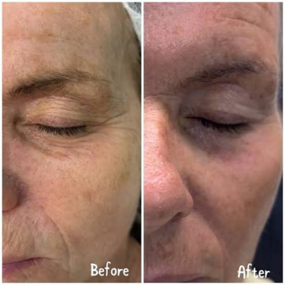 ✨ Vitti-Pure Under-Eye Rejuvenation at Cedar & Sage Aesthetics & Wellness in Hiawassee, GA