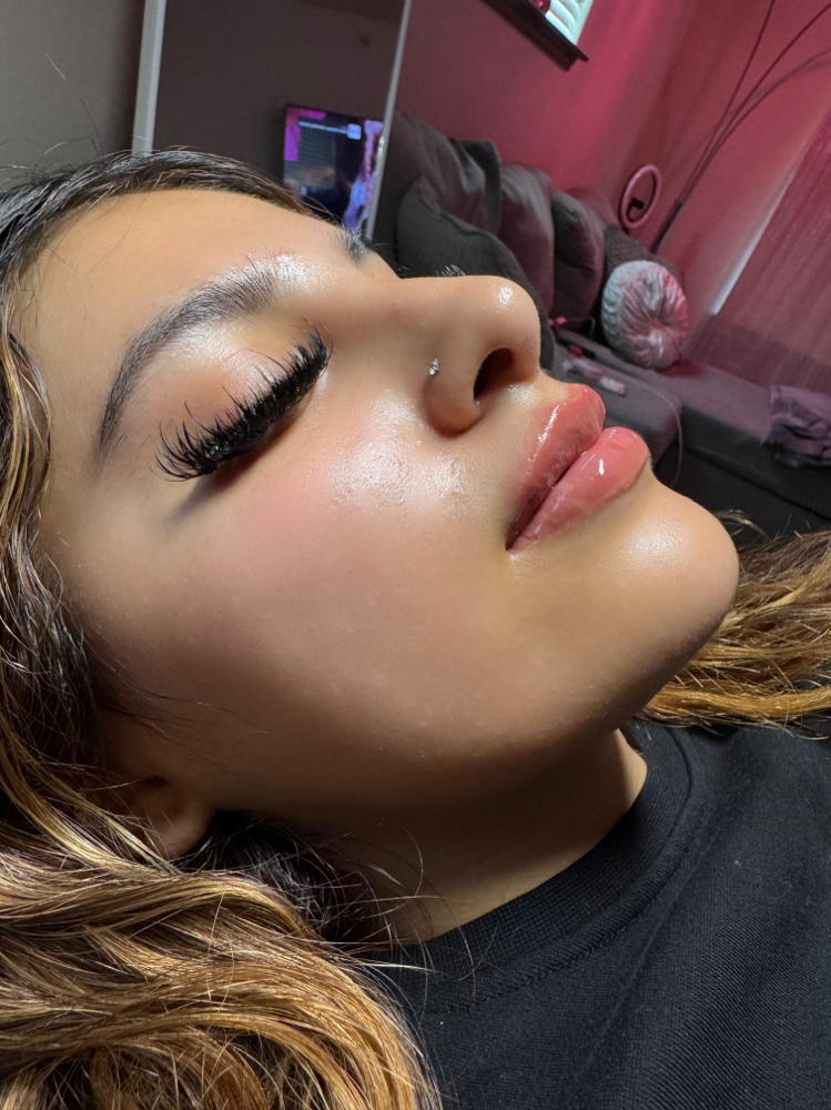 Lip Filler