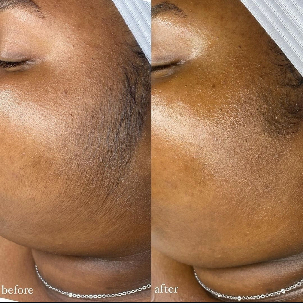 Dermaplaning (Ad-on To Facial)