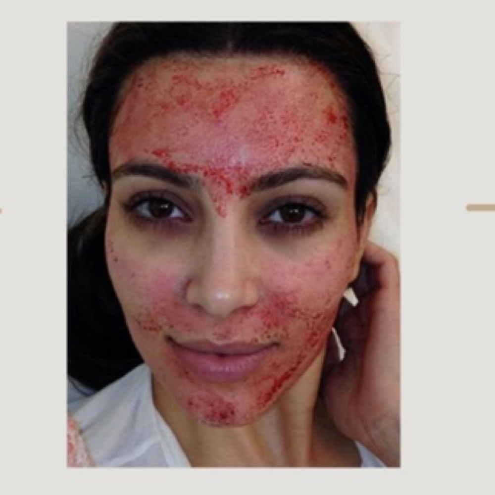 Vampire Facial (PRP Microneedling) at TRES Aesthetics in Missouri, TX