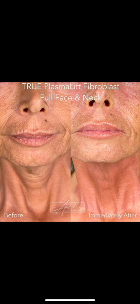 PLASMALIFT FIBROBLAST TREATMENT