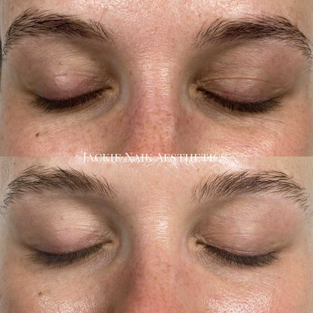 Hydrafacial Eye Perk Add-On