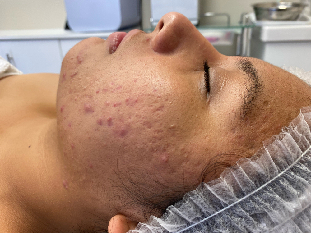 Acne Treatments