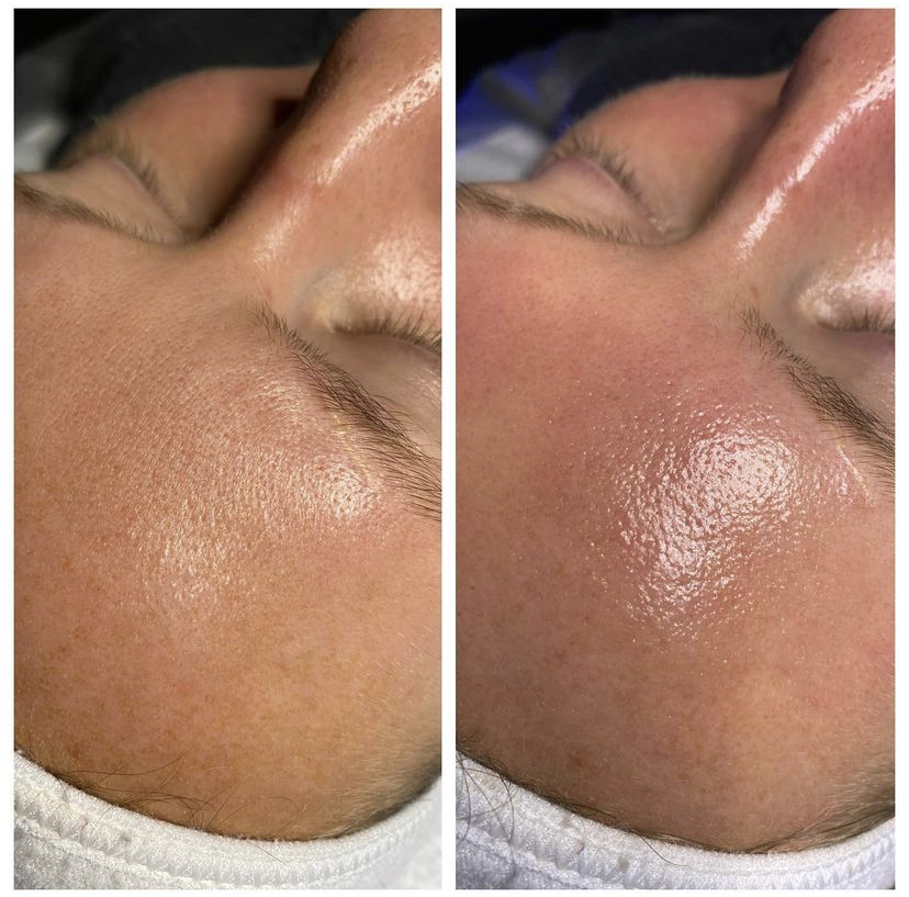 Signature HydraFacial