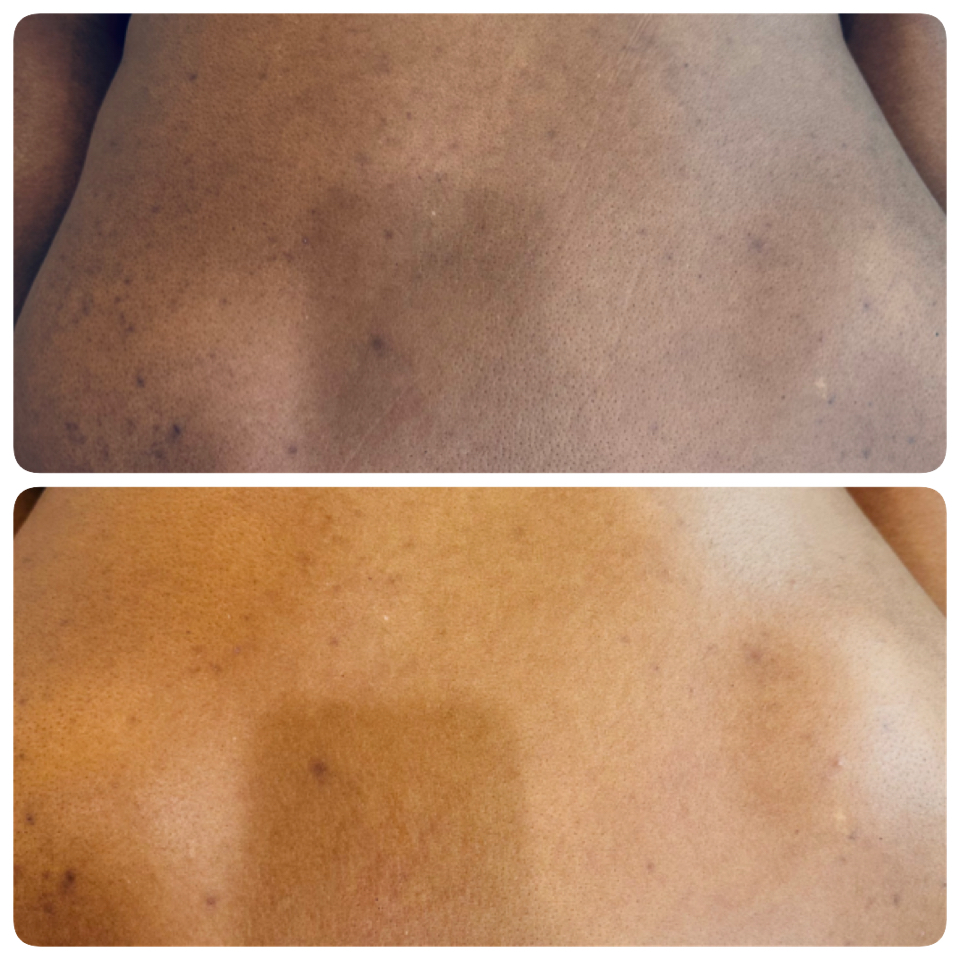 SiMonet Back Facial