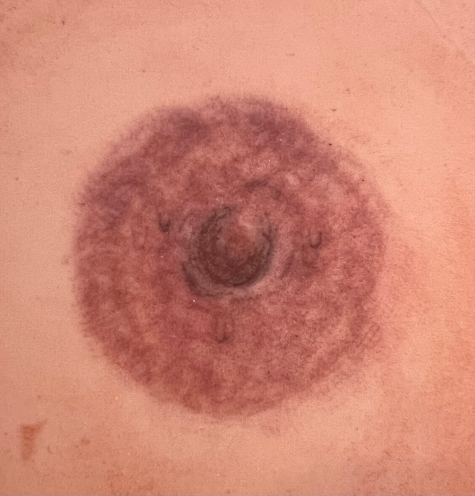 Areola Restoration