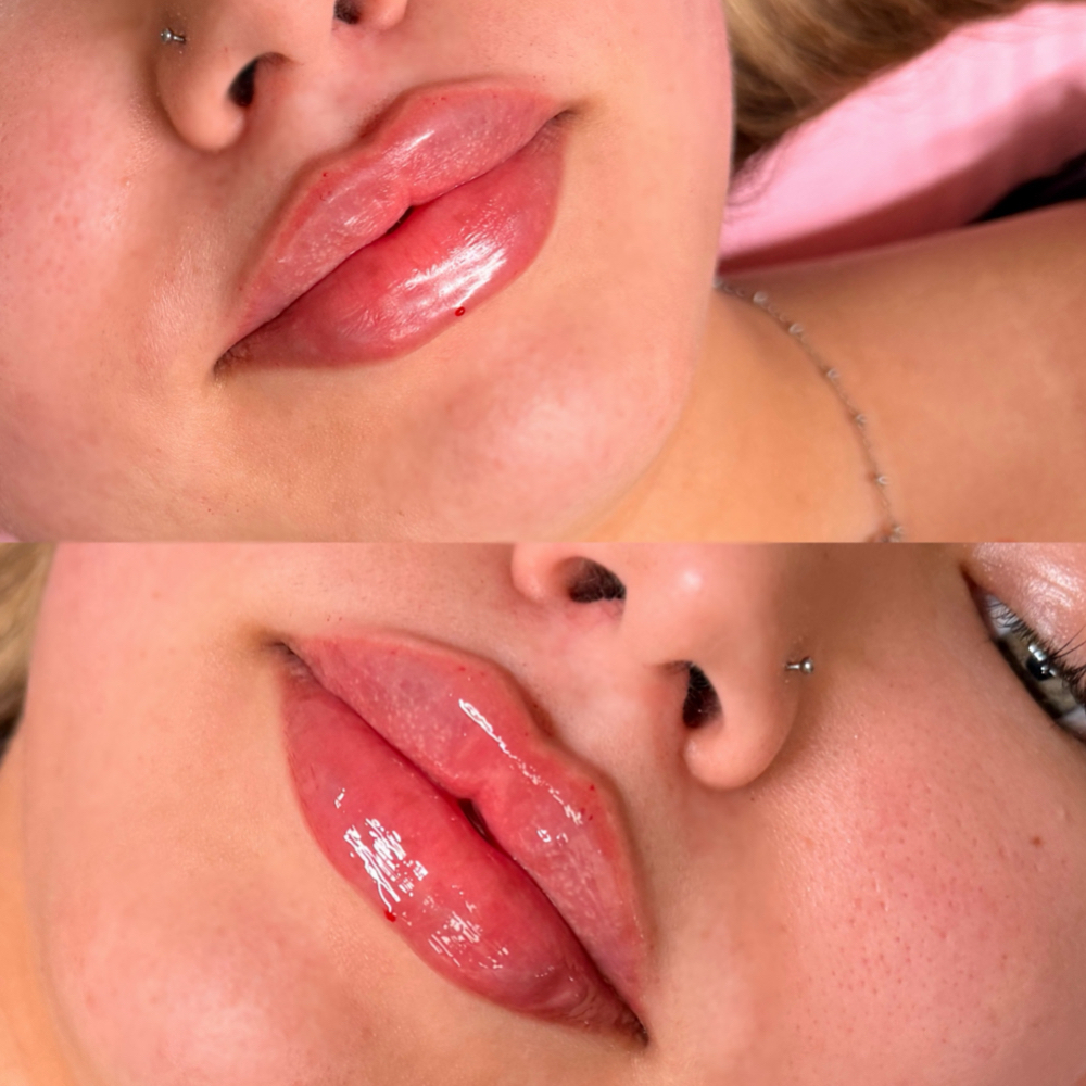 Lip Filler at The Sculpting Spa in Alice, TX