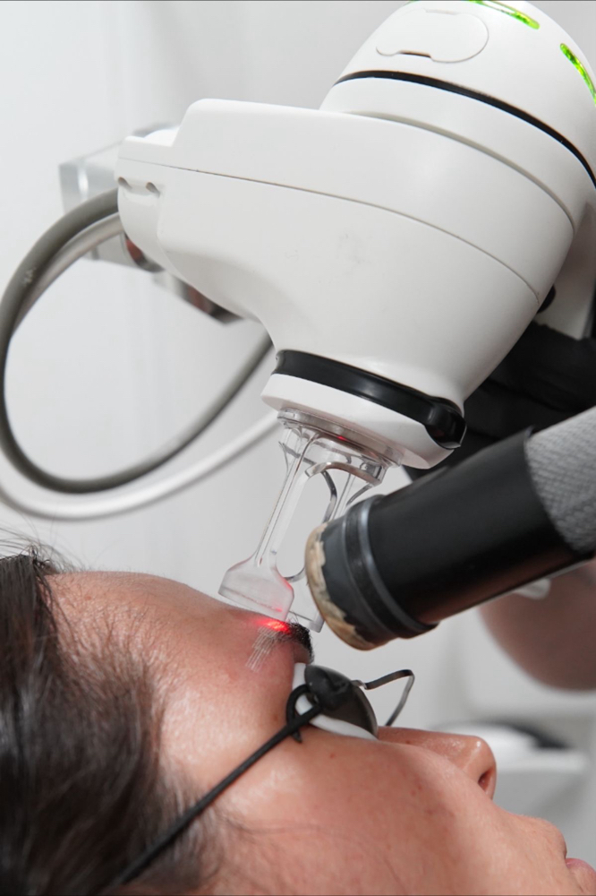 Laser Brow Tatto Removal