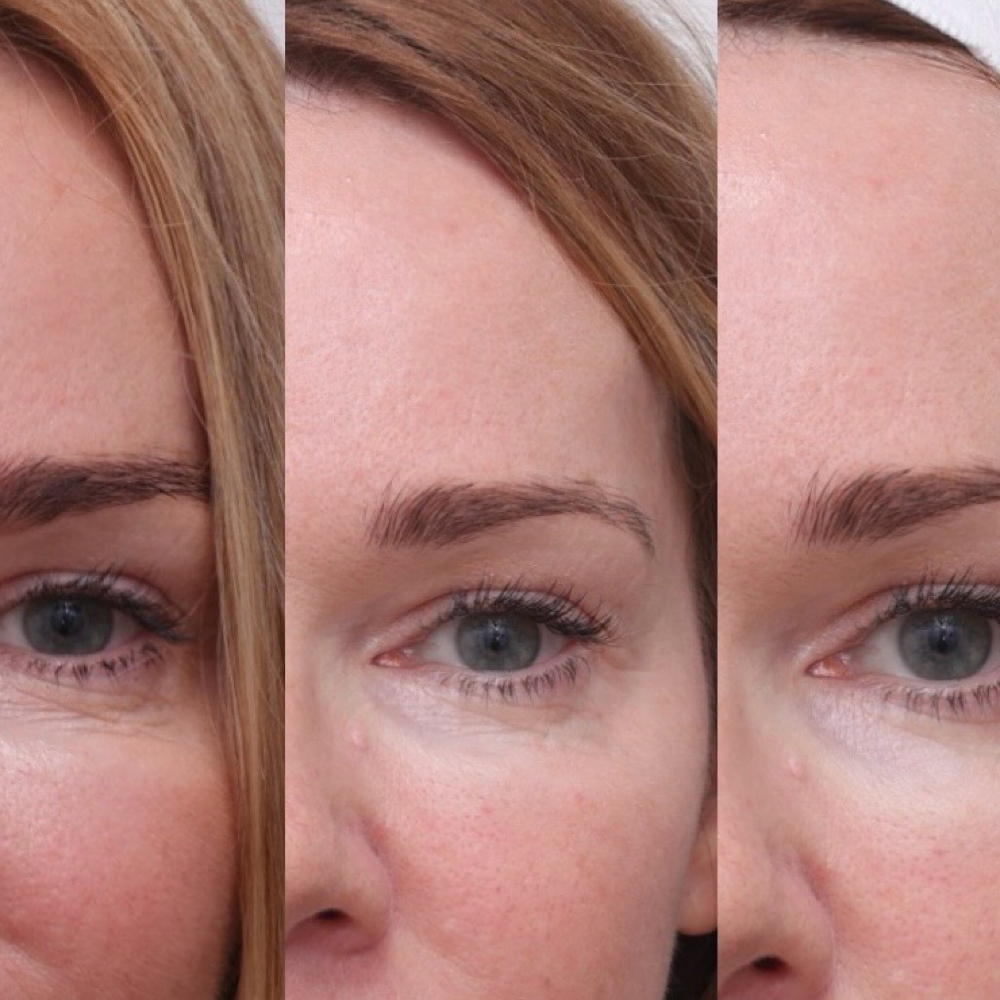 REJURAN PDRN GLOW RESET at Mily Aesthetics in Newark, NJ