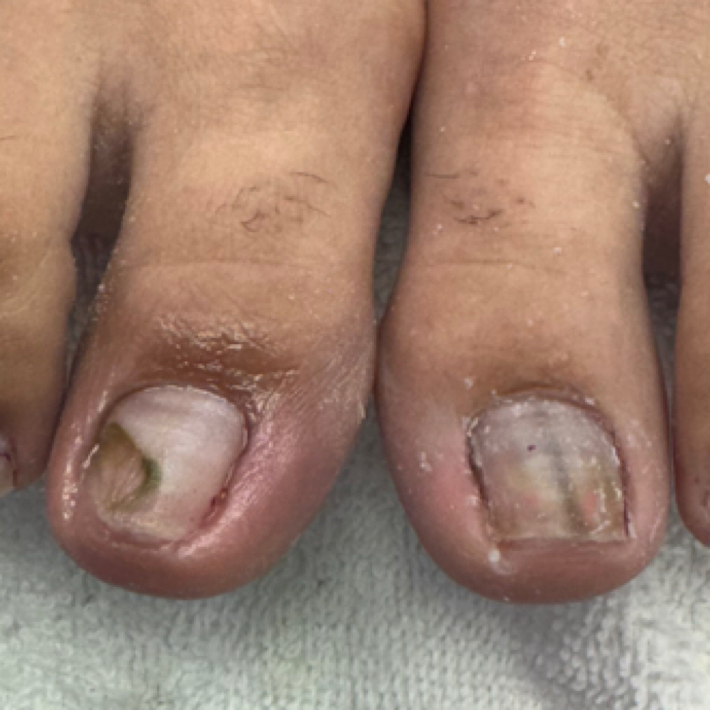 Uña Con Condición at Rut Albornoz/Foot Care37 in Rhode Island, RI
