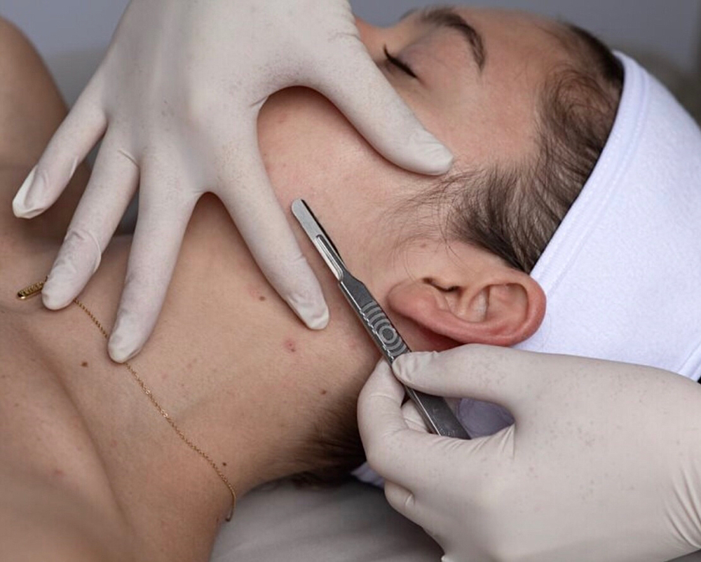 Dermaplaning