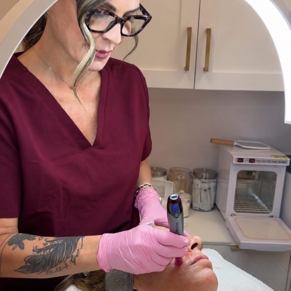 Microneedling with Numbing at Skyn Esthetics INC. in Boca Raton, FL