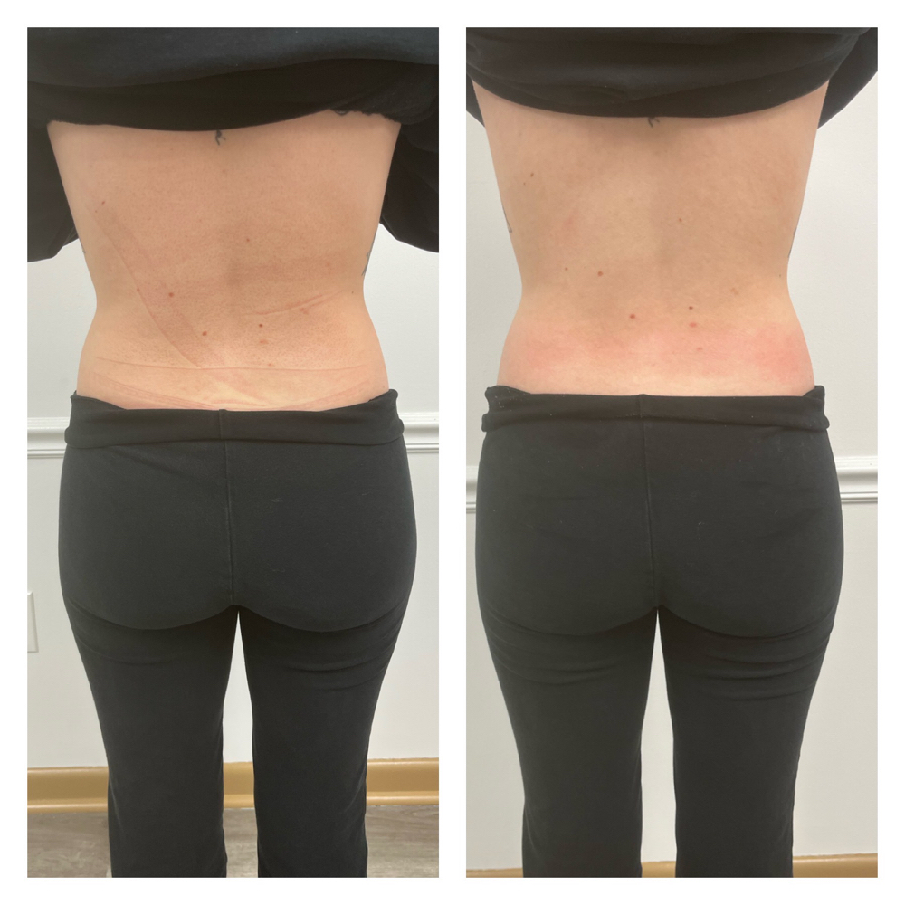 Back Fat Removal at Alexis Kirby in Dayton, OH
