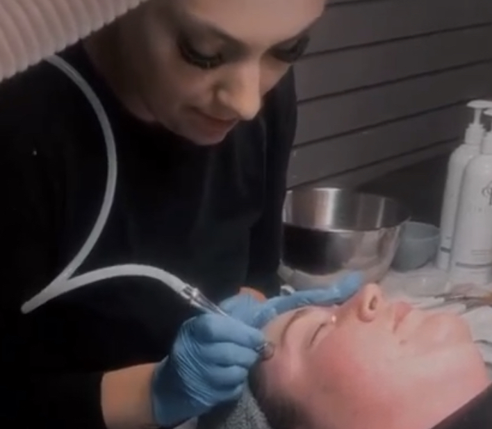 *Add On* Microdermabrasion