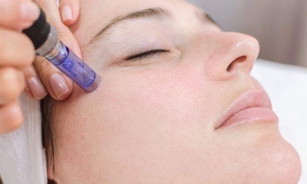 Microneedling