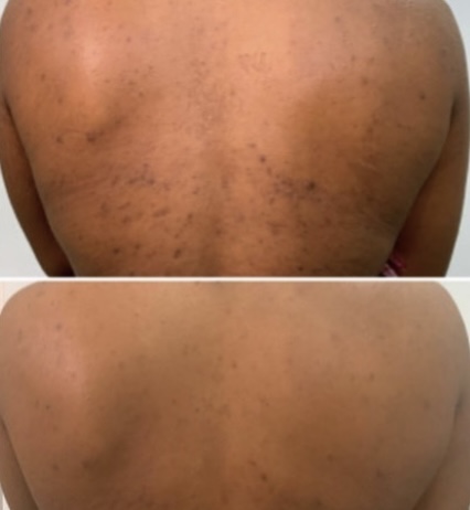 Back Peeling/Despigmentación Espald