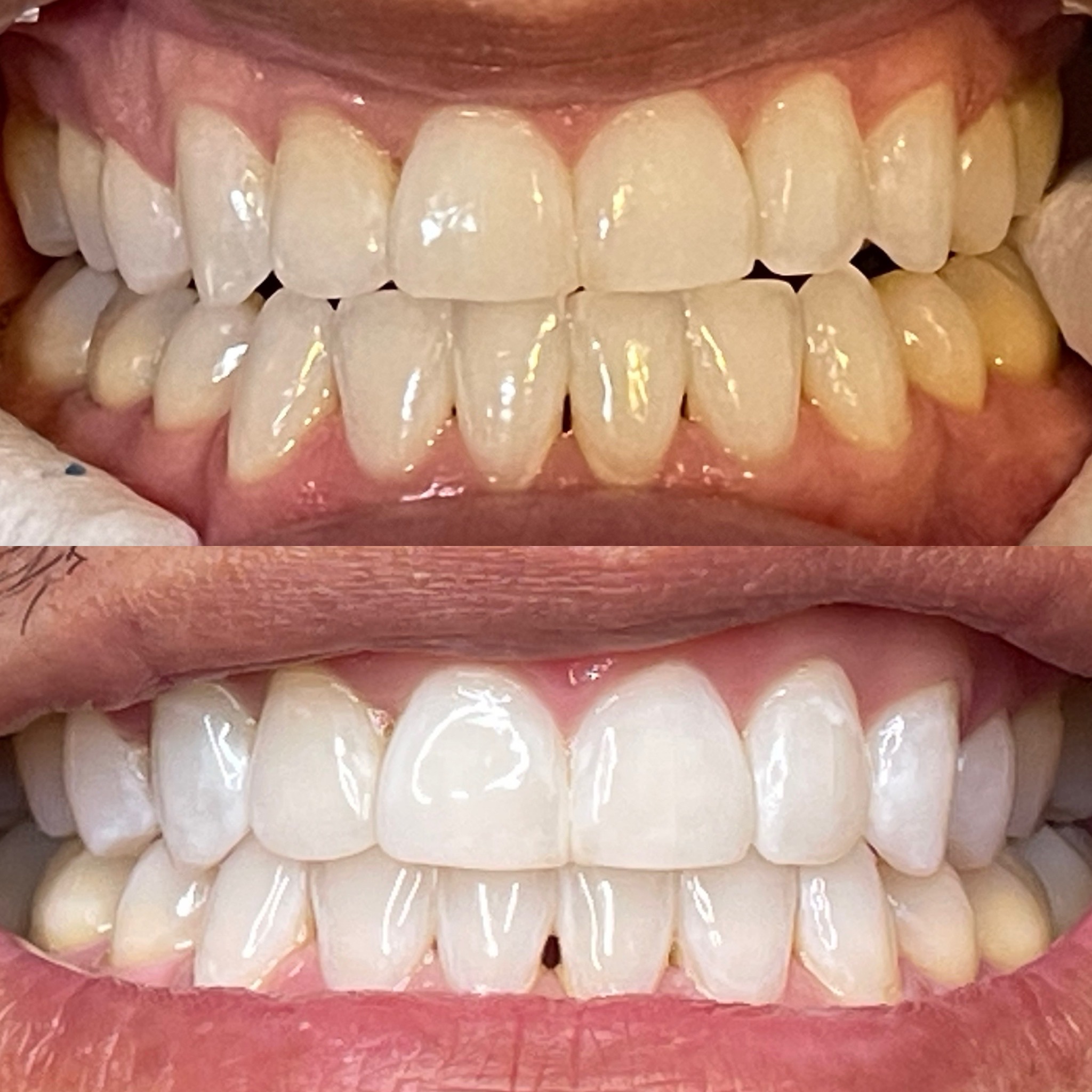 90 Minute Teeth Whitening at Smiles By Ali✨ in Arlington, TX