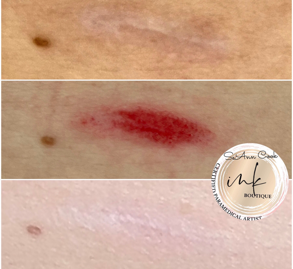 Scar Revision/ Camouflage at Beauty Edit in Fairview, OR