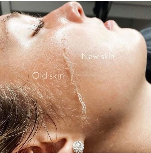 Dermaplane Facial
