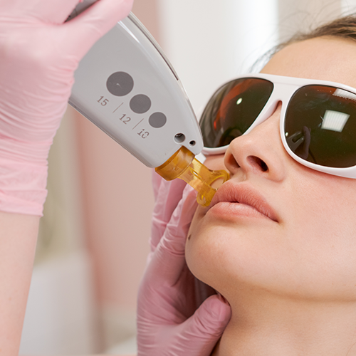 Depilacion Laser - Vello Facial at EJ Beauty Center in Norfolk, VA