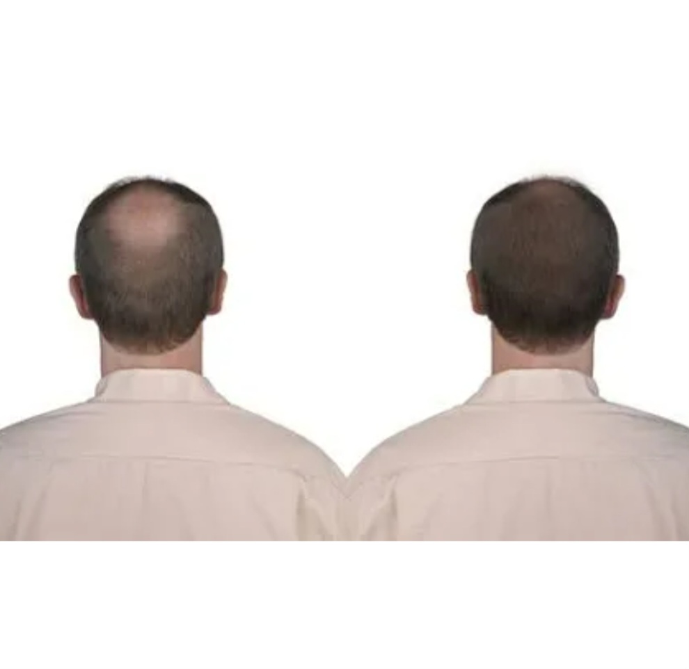 PRP Hair Rejuvenation