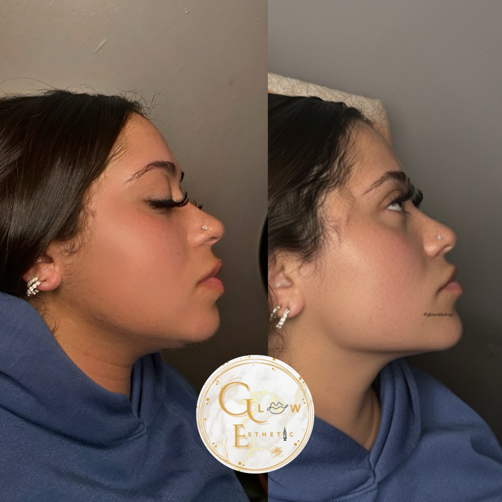 Definicion Mandibular y Menton at Glow Esthetic NY in Buffalo, NY