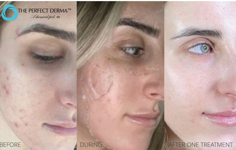 The Perfect Derma Peel