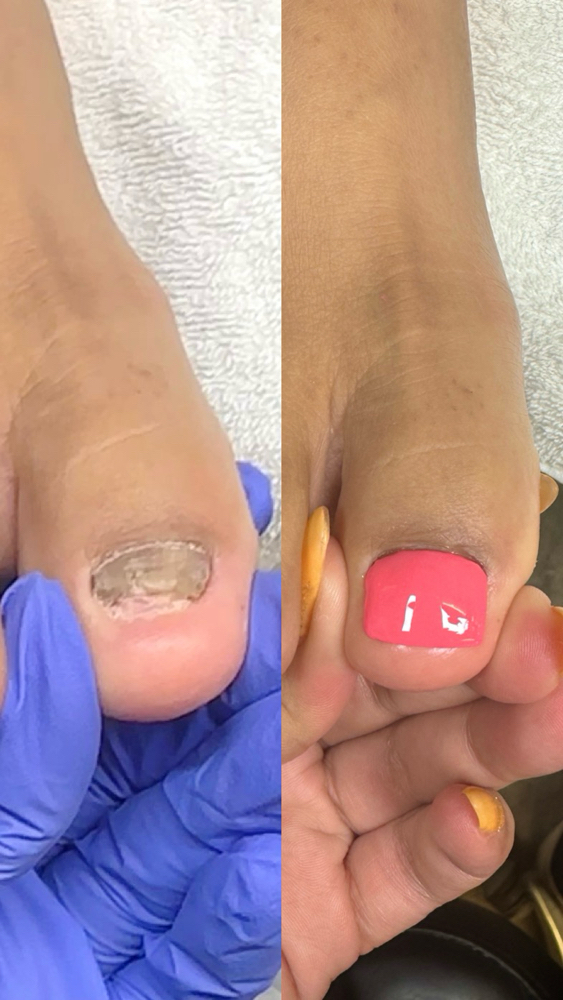 Toenail Reconstruction • FOLLOW UP