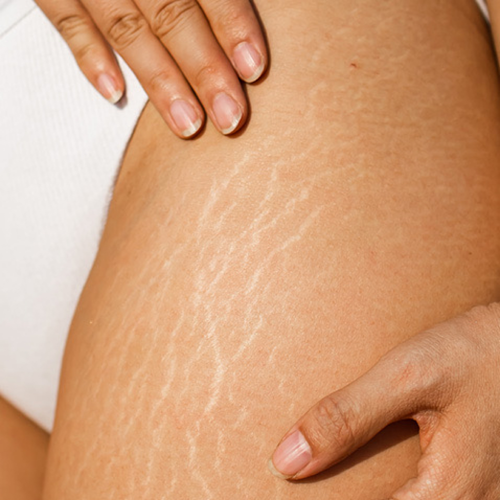 Stretch Mark Revision Consultation