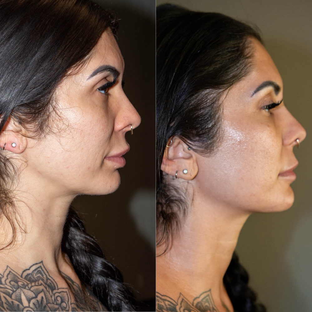 Plasma Firm + Restore Facial at Jo Saucedo Aesthetics in Tigard, OR