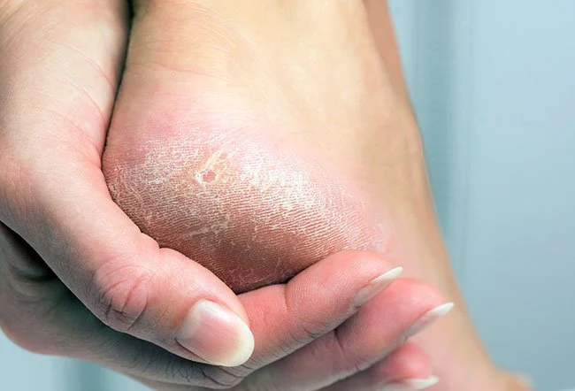 Callus Remover