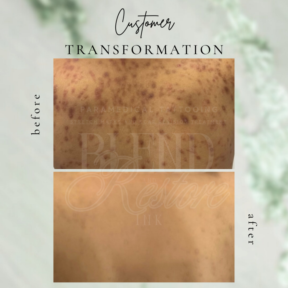 Back Acne Scars
