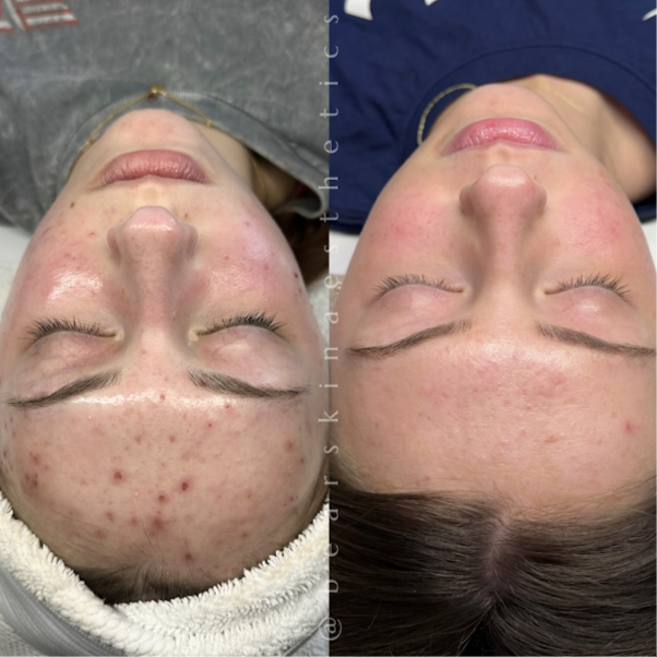 Clarity+Correction | Acne Program at Rachel Fleming in Castelton, NY