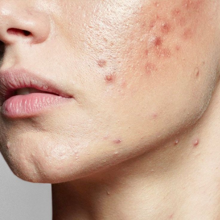 Performance Acne (Facial) MedPeel at THE MED BAR in Colorado, CO