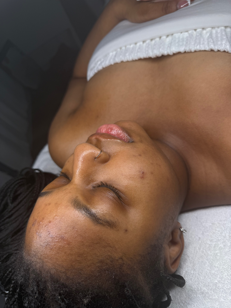 Leveled 1-2 Chemical Peel Treatment