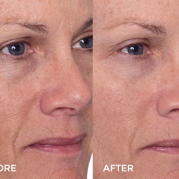 Age-Renewal Peel at MediGlow Spa in Spring, TX