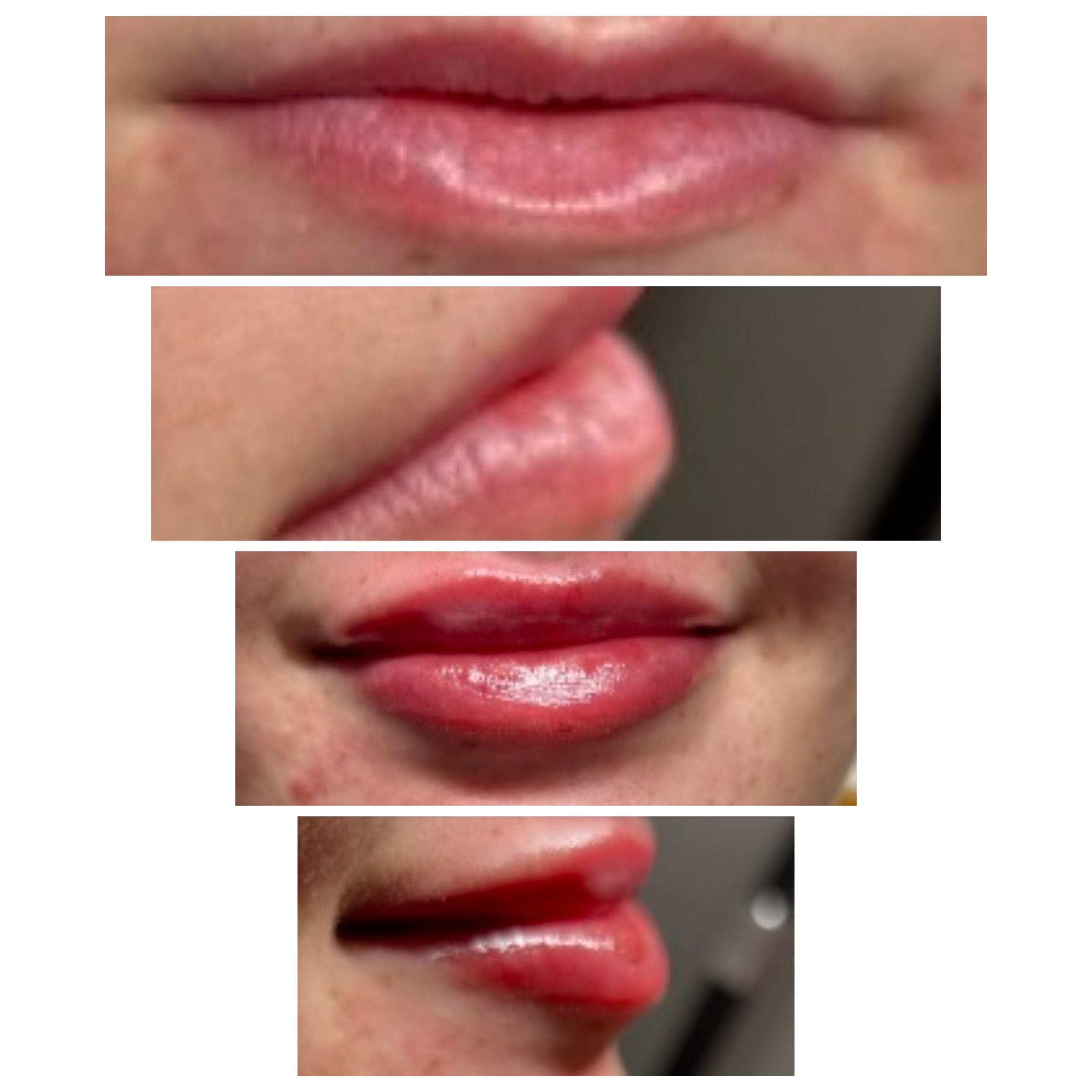 Lip Filler at EVLO Salon Suites in Nampa, ID