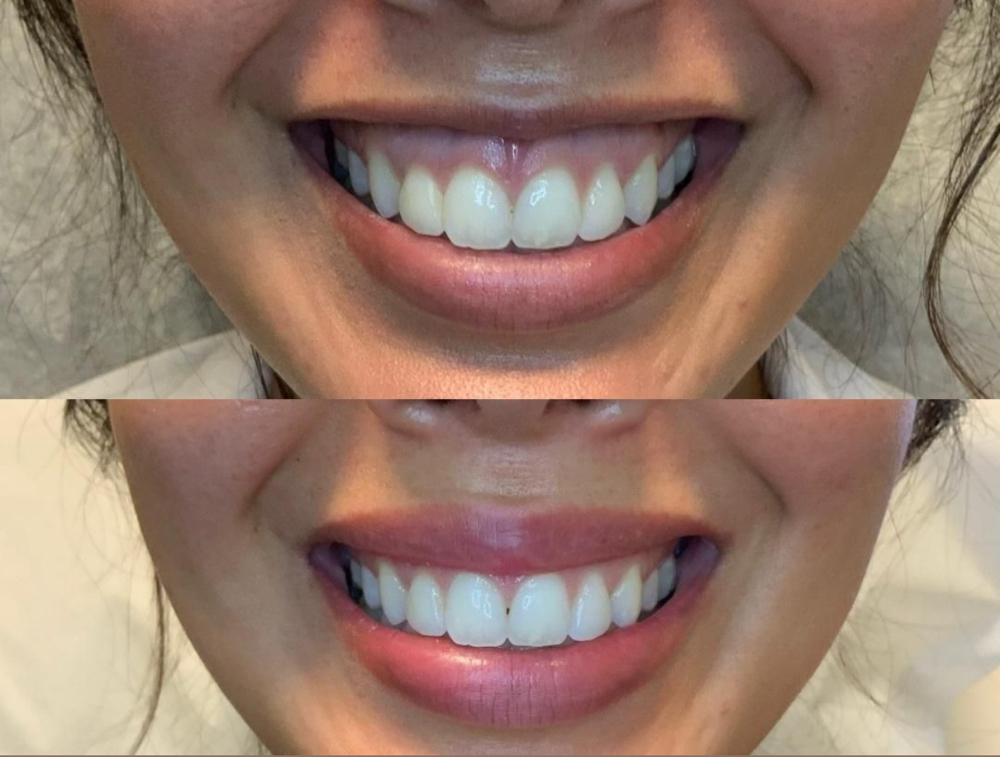 Lip Flip at Balance.Bar.Aesthetics in Berkeley, CA