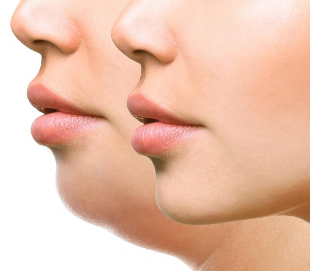 Kybella