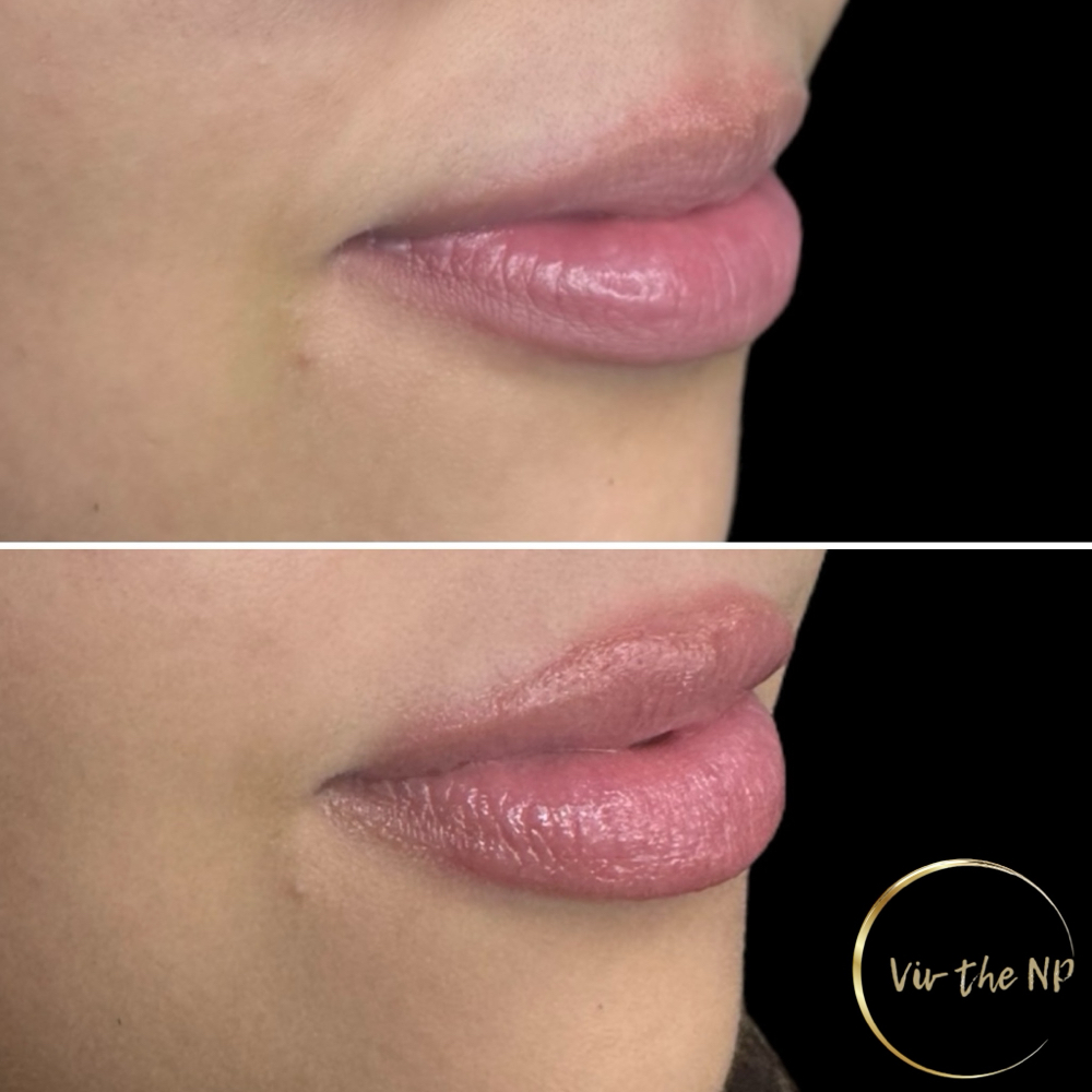 Half Syringe Lip Filler
