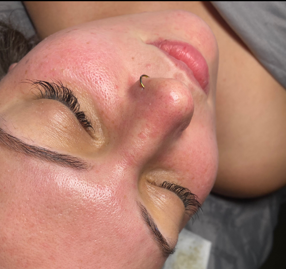 Microdermabrasion Facial