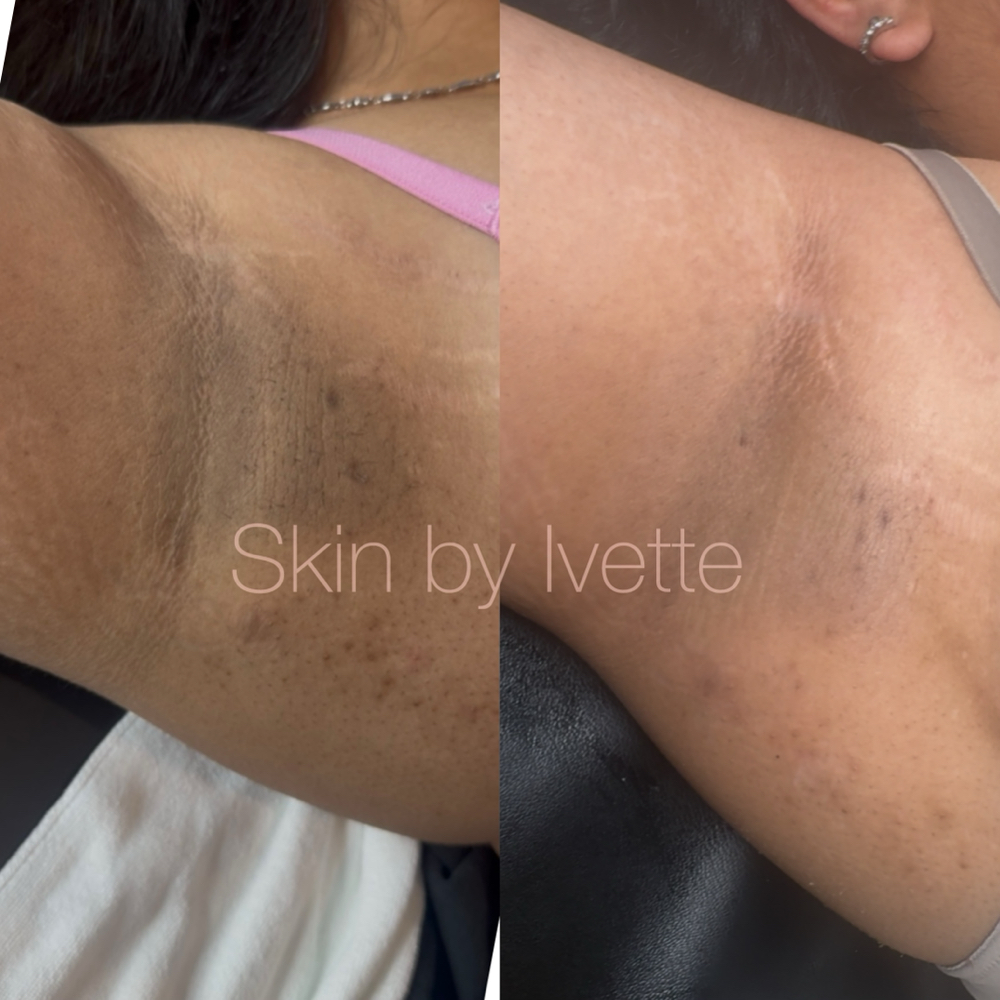 Underarm Lightening at Skin by Ivette in Valley Village, CA