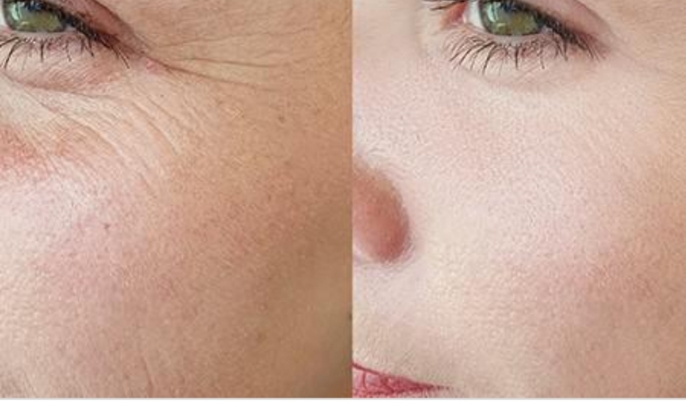 Microneedling