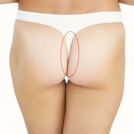 Butt Strip (Women) at Bareline Aesthetics in Brea, CA
