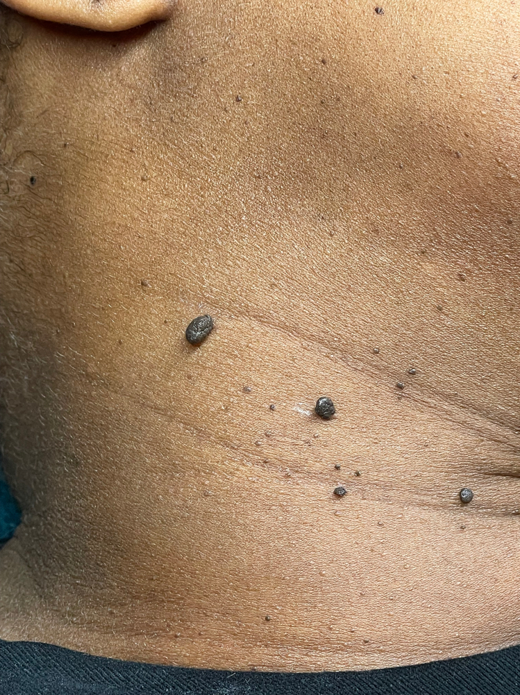 DPN Mole removal